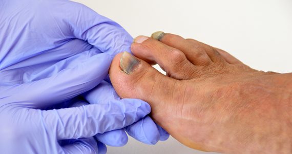 Pathologies des ongles