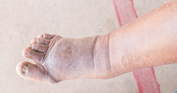 Chronic Venous Insufficiency or Chronic Venous Disease