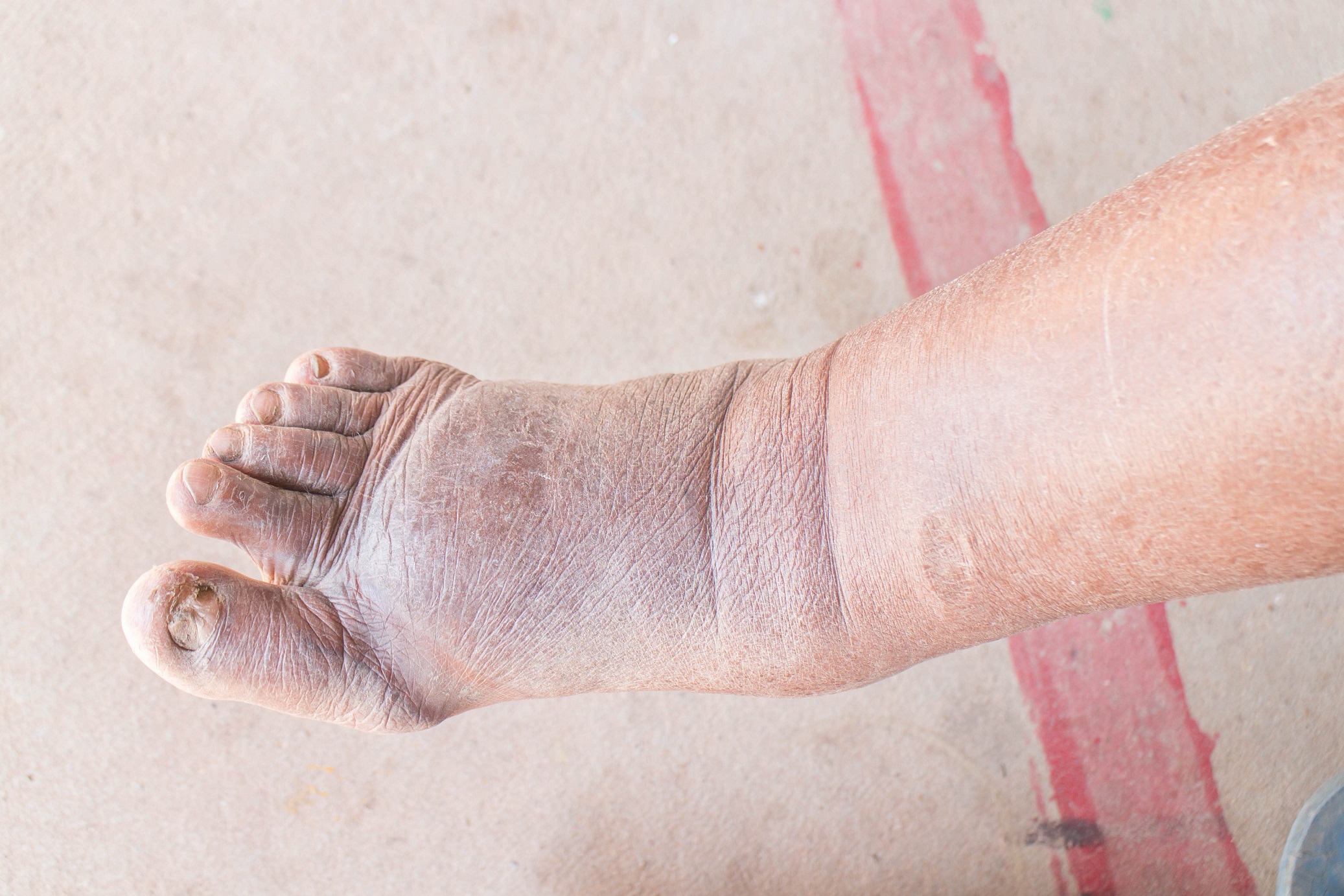 Venous insufficiency: what it is, causes and symptoms - Blog