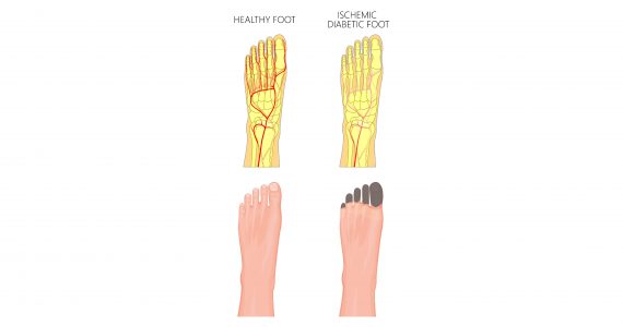 Neuropathic and ischaemic foot