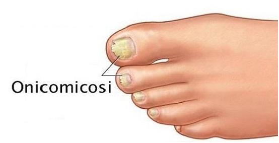 Types of onychomycosis