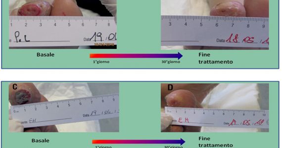 Care for the diabetic foot ulceration: the skin reepithelialization importance