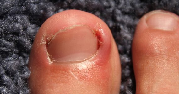 Ingrown toenail: what is it and which remedies are available