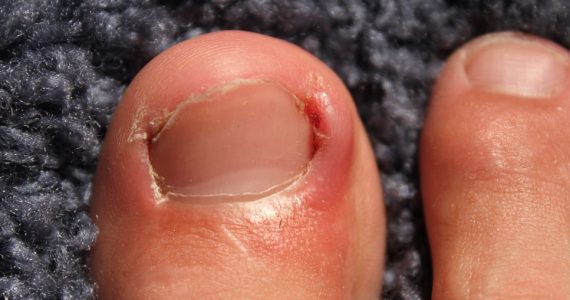 Ongle incarné: qu’est ce que c’est et quels remèdes