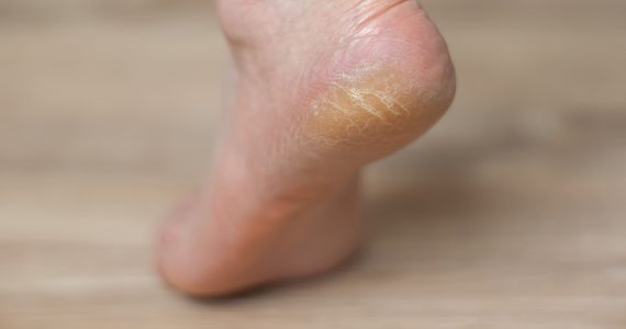 Foot hyperkeratosis: how to normalize skin physiology